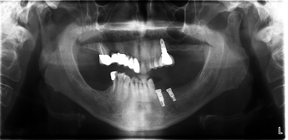 Implantater og tannimplantater