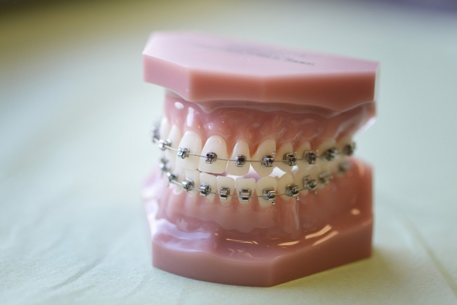 Staten reduserer sine takster til tannregulering